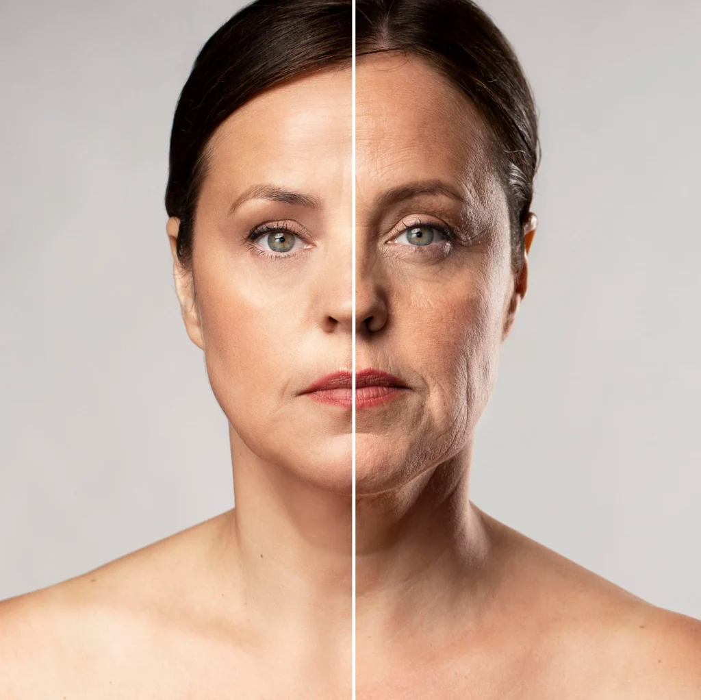 Female patient before and after at Elysian Medspa & Rejuvenation Center