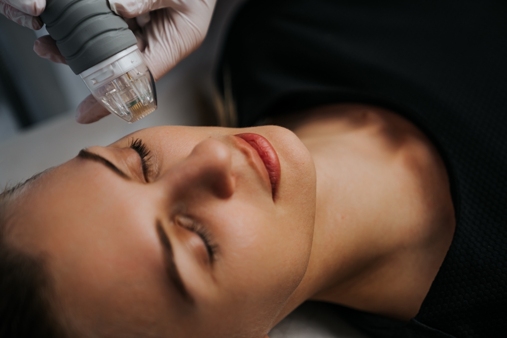 Patient receiving Morpheus8 treatment for the face at Elysian Medspa & Rejuvenation Center