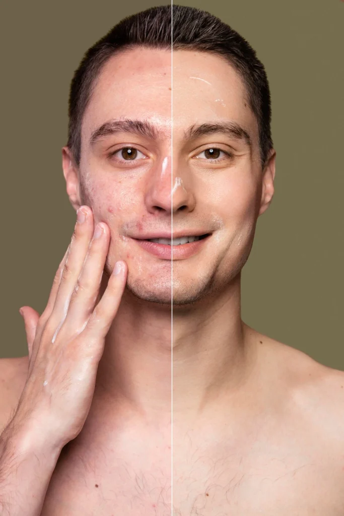 Patinet before and after at Elysian Medspa & Rejuvenation Center