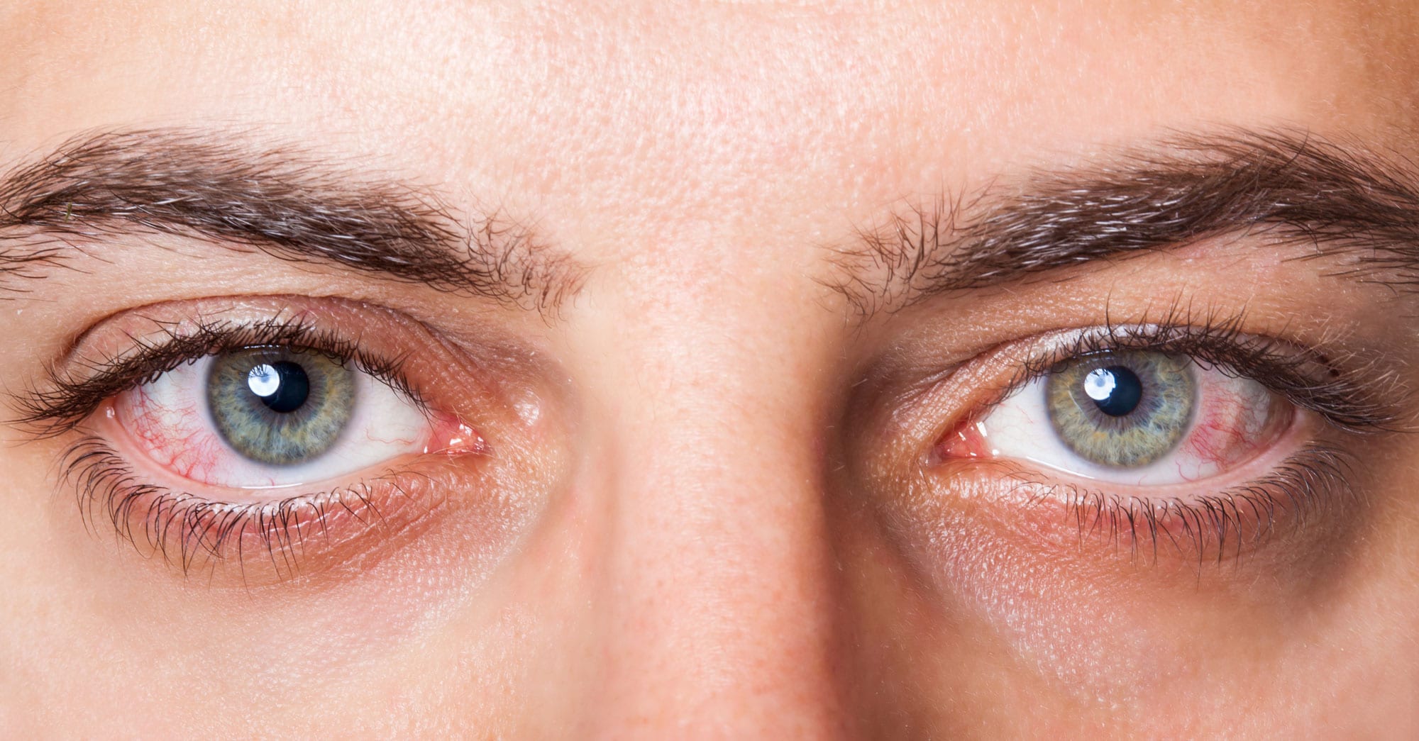 Patient at Elysian Medspa & Rejuvenation Center with Dry Eyes