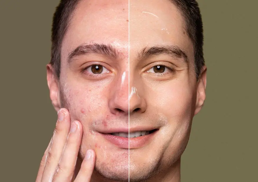 Portrait of male patient with half before & half after shot after PICO laser treatment at Elysian Medspa & Rejuvenation Center in Indianapolis